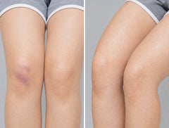 Bruising / Poor Circulation